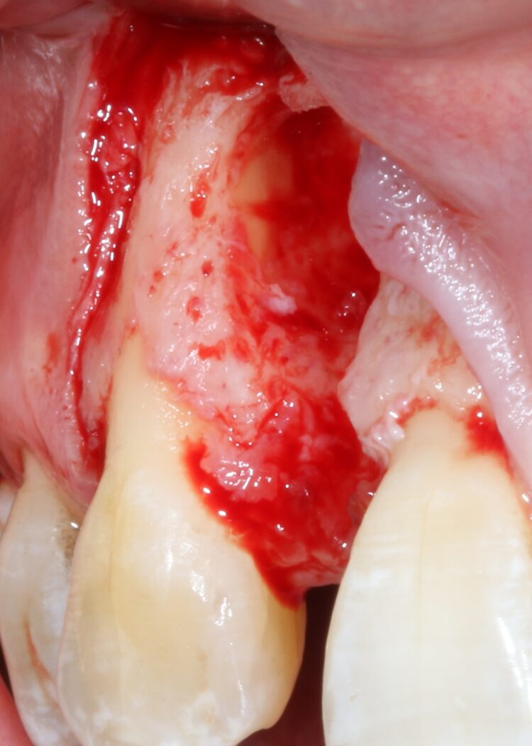 Fig 6b - UR3 root exposure