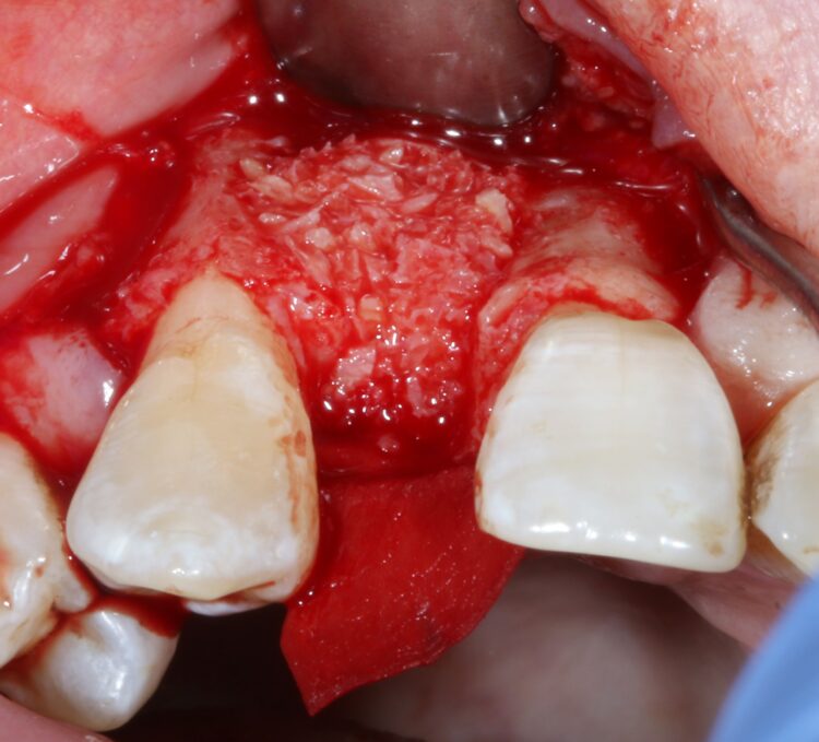 Fig 7 - Rebuilding of the bone defect with a particular bone graft