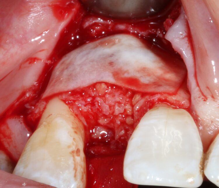 Fig 8 - Collagen membrane placed to protect the bone graft
