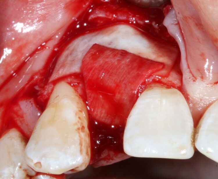 Fig 9 - Occlusal aspect of the graft covered with shorter acting collagen membrane