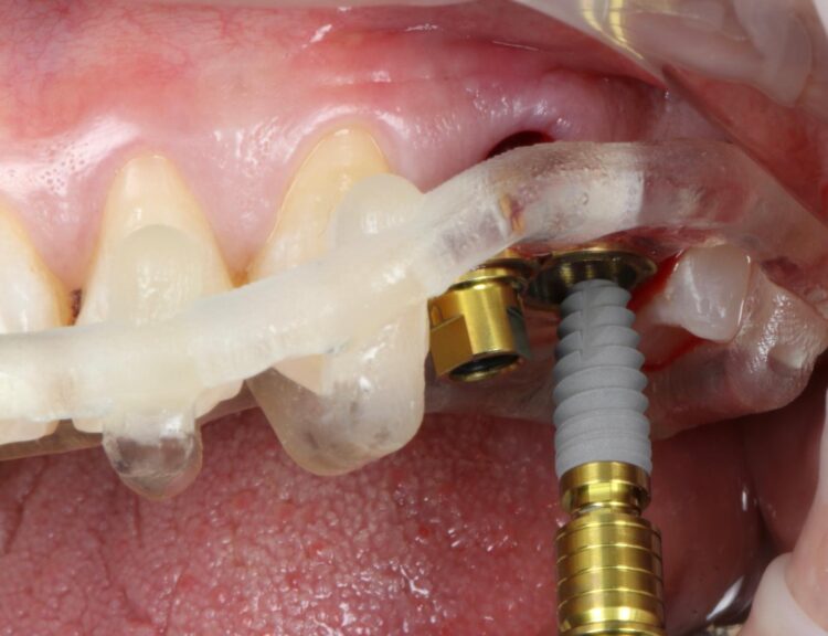 fully-guided immediate implant