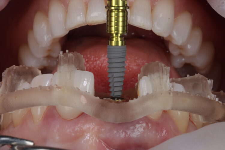 Figure 10: CONELOG 3.8mm implant placed through guide