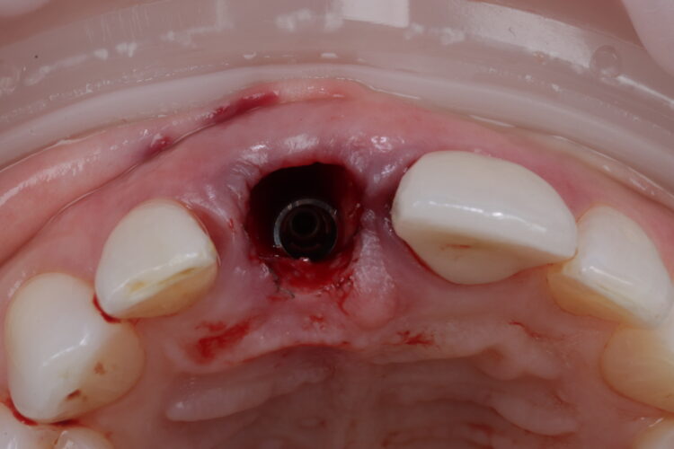 Figure 11: Implant placed in close contact to palatal bone with jump gap visible