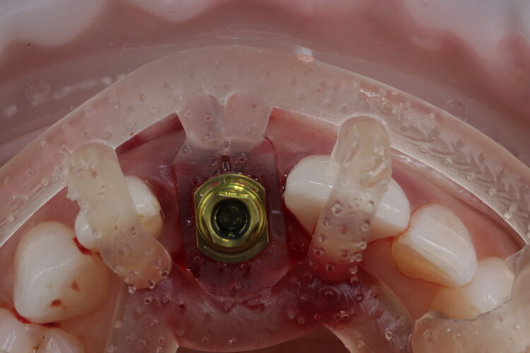 Figure 12: Implant delivered fully guided