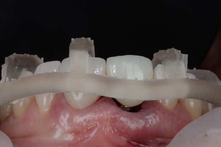 Figure 14a: Lab temporary tried in with SMOP verification