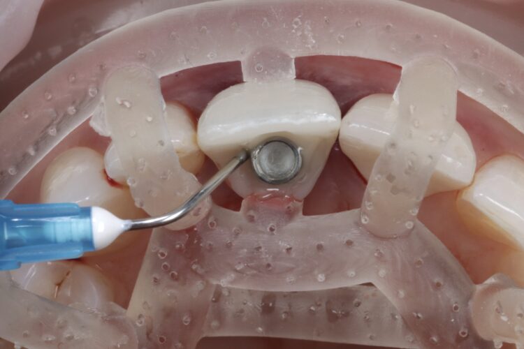 Figure 15: Flowable composite attaching temporary to abutment
