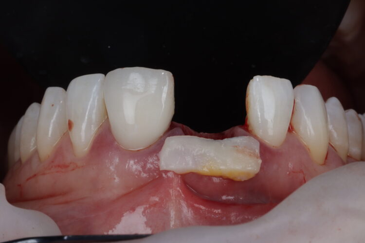 Figure 16: CTG placed from papilla to papilla
