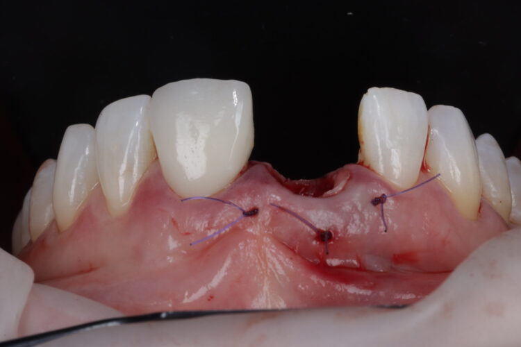 Figure 17: CTG stabilised from papilla to papilla