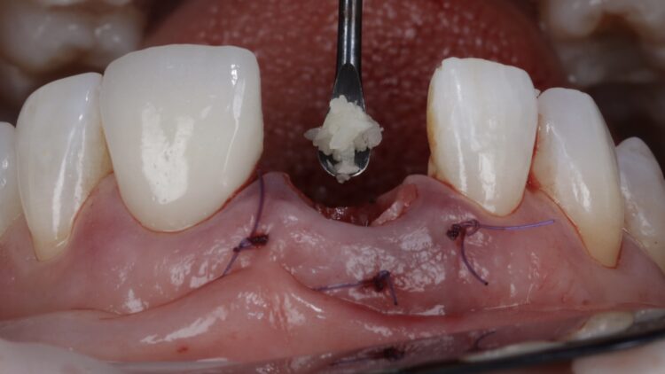 Figure 18: MinerOss Blend added to jump gap