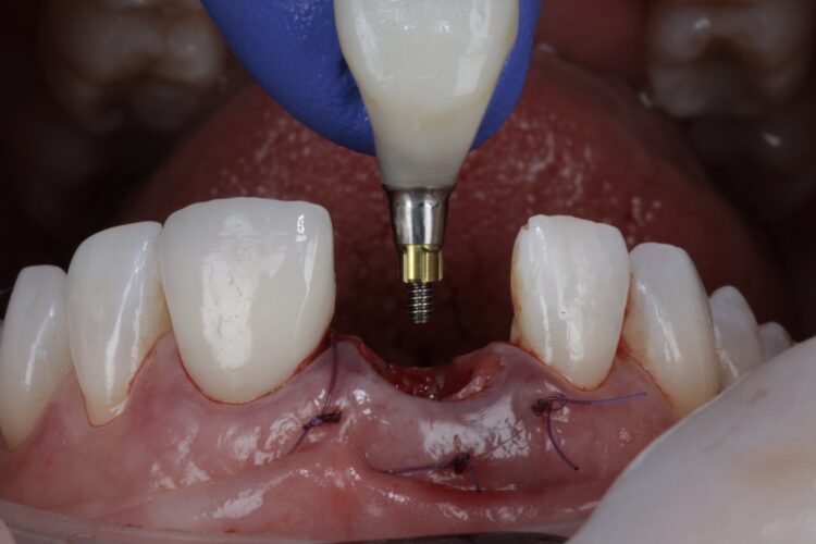 Figure 19: Temporary restoration try in