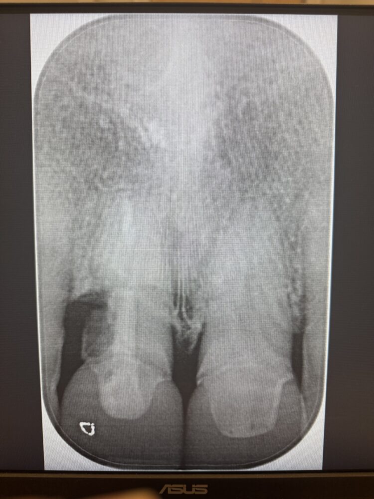 Figure 2: Pre-operative radiograph