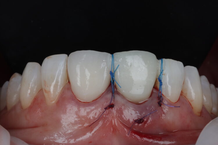 Figure 20: Site is closed with vertical sling suture, placing the soft tissue in close approximation to the subgingival profile of the restoration