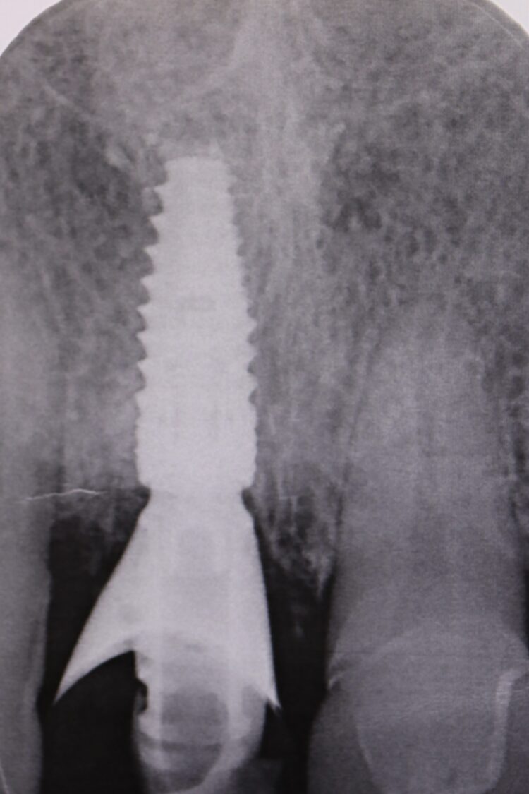 Figure 21: Post-operative radiograph without compressing crestal bone