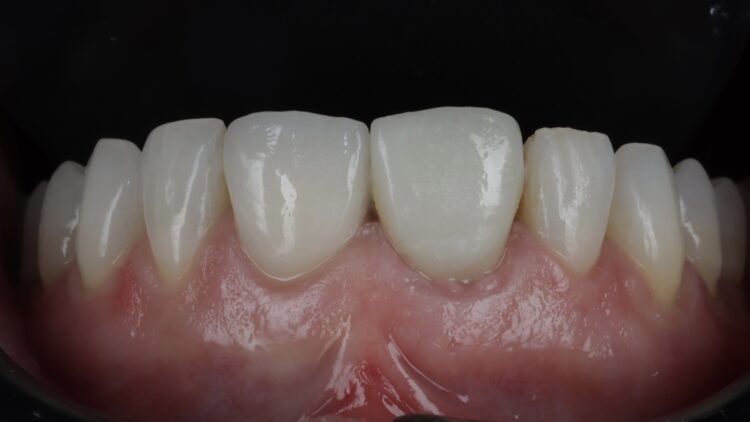 Figure 22: Eight week post-operative review