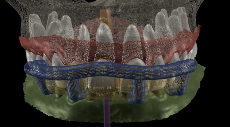 Figure 3: Digital planning for surgical guide