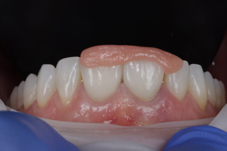 Figure 5: Verification jig if original crown were to be used