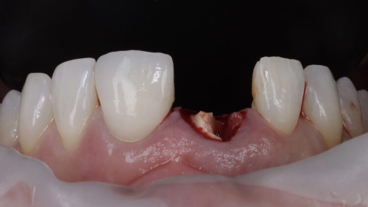 Figure 6: Post crown removed, distal resorption visualised, and root sectioned