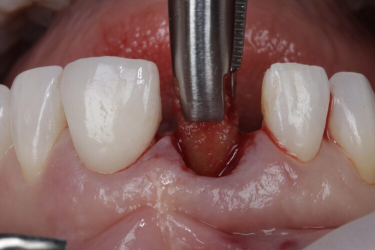 Figure 7: Forceps used to remove fragments