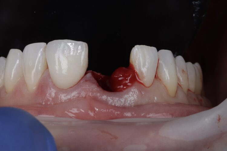 Figure 8: Granulation tissue removed