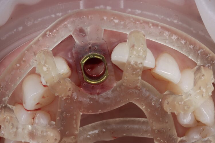Figure 9: Surgical guide fit check to ensure accurate seating